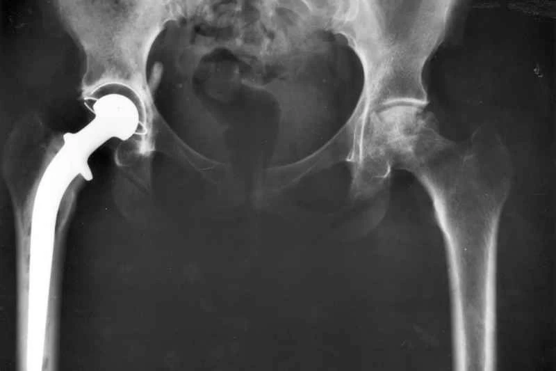 科學研究表明，某些性愛姿勢不會損害你的人工髖關節。