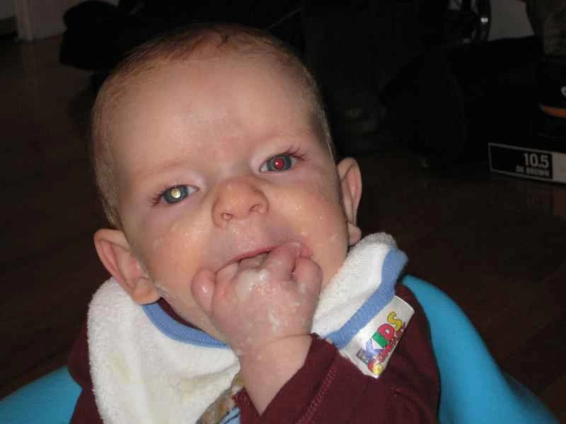 嬰兒照片可診斷致命癌症